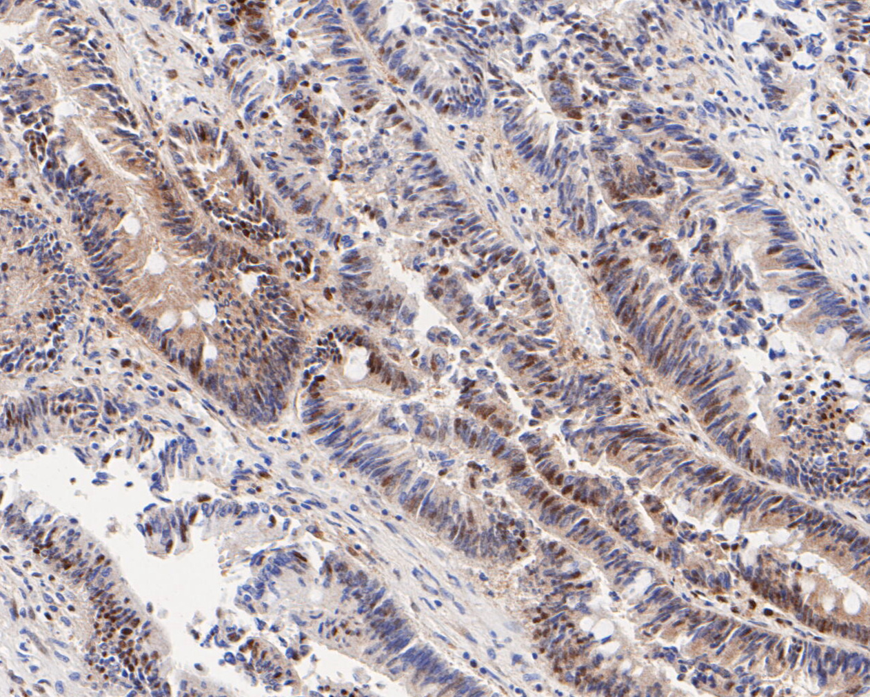 Immunohistochemical analysis of paraffin-embedded human colon carcinoma tissue using anti-CIRP antibody. The section was pre-treated using heat mediated antigen retrieval with sodium citrate buffer (pH 6.0) for 20 minutes. The tissues were blocked in 5% BSA for 30 minutes at room temperature, washed with ddH2O and PBS, and then probed with the primary antibody (ET7111-15, 1/200)  for 30 minutes at room temperature. The detection was performed using an HRP conjugated compact polymer system. DAB was used as the chromogen. Tissues were counterstained with hematoxylin and mounted with DPX.