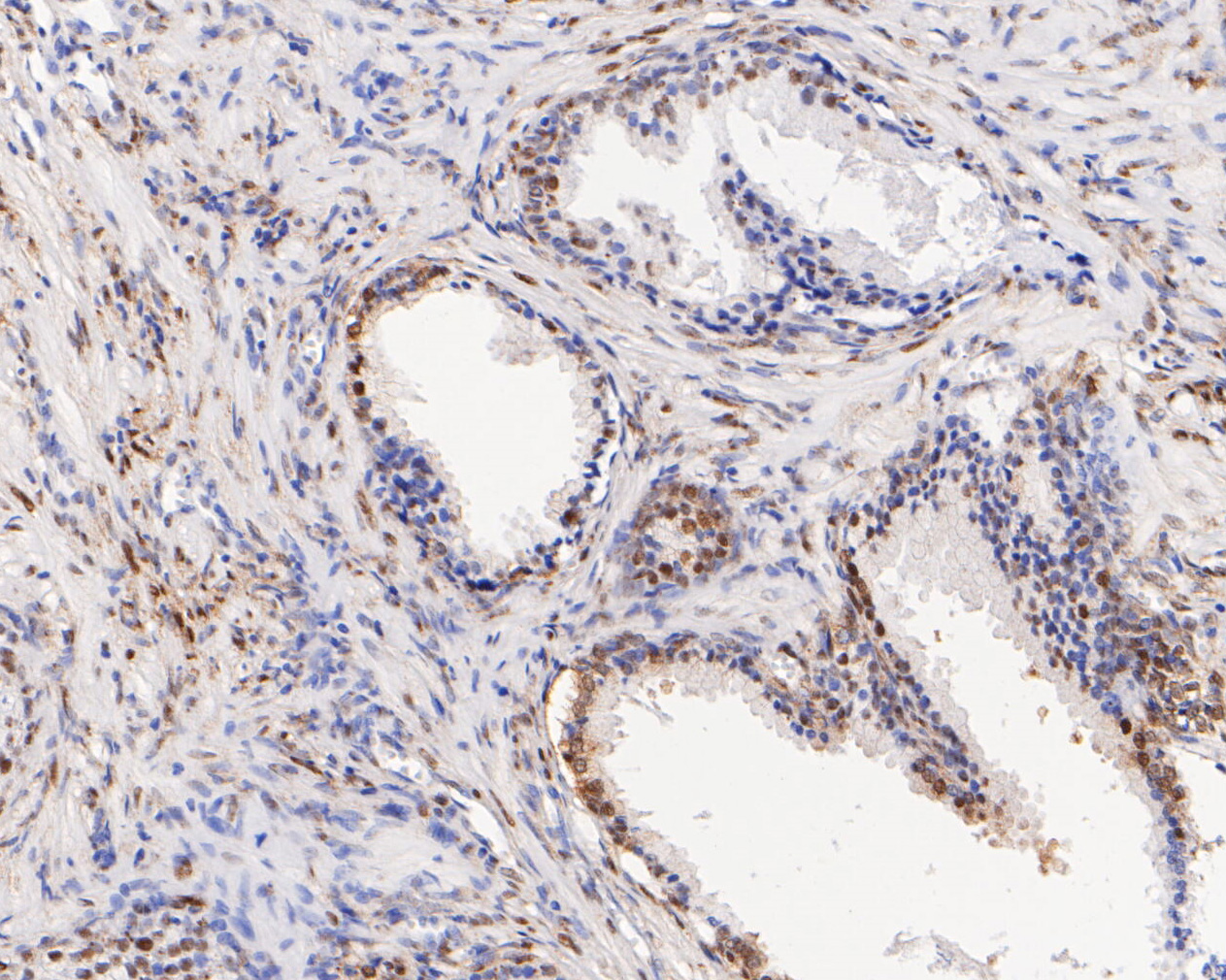Immunohistochemical analysis of paraffin-embedded human prostate carcinoma tissue using anti-CIRP antibody. The section was pre-treated using heat mediated antigen retrieval with sodium citrate buffer (pH 6.0) for 20 minutes. The tissues were blocked in 5% BSA for 30 minutes at room temperature, washed with ddH2O and PBS, and then probed with the primary antibody (ET7111-15, 1/200)  for 30 minutes at room temperature. The detection was performed using an HRP conjugated compact polymer system. DAB was used as the chromogen. Tissues were counterstained with hematoxylin and mounted with DPX.