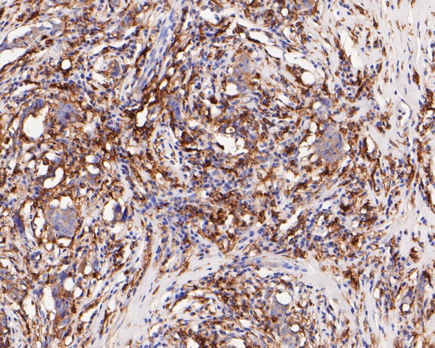 Immunohistochemical analysis of paraffin-embedded human breast carcinoma tissue using anti-HLA-DRB4 antibody. The section was pre-treated using heat mediated antigen retrieval with Tris-EDTA buffer (pH 8.0-8.4) for 20 minutes.The tissues were blocked in 5% BSA for 30 minutes at room temperature, washed with ddH2O and PBS, and then probed with the primary antibody (ET7111-17, 1/200) for 30 minutes at room temperature. The detection was performed using an HRP conjugated compact polymer system. DAB was used as the chromogen. Tissues were counterstained with hematoxylin and mounted with DPX.