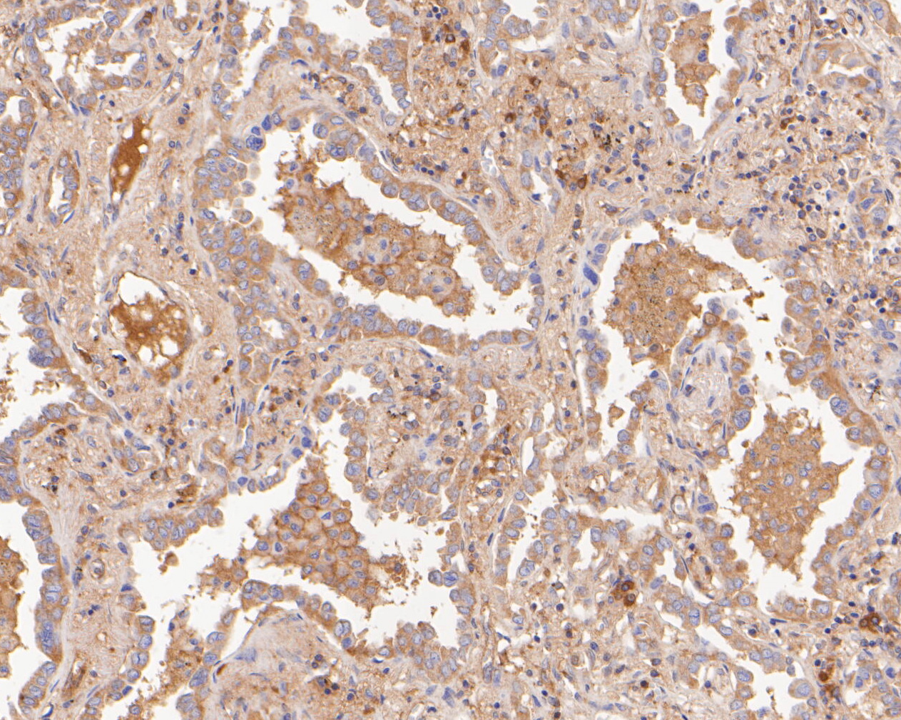 Immunohistochemical analysis of paraffin-embedded human lung carcinoma tissue using anti-CARS antibody. The section was pre-treated using heat mediated antigen retrieval with Tris-EDTA buffer (pH 8.0-8.4) for 20 minutes.The tissues were blocked in 5% BSA for 30 minutes at room temperature, washed with ddH2O and PBS, and then probed with the primary antibody (ET7111-18, 1/200) for 30 minutes at room temperature. The detection was performed using an HRP conjugated compact polymer system. DAB was used as the chromogen. Tissues were counterstained with hematoxylin and mounted with DPX.