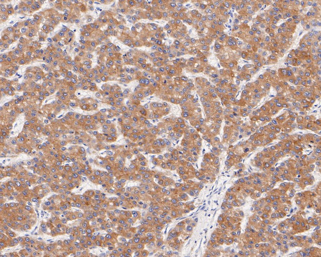 Immunohistochemical analysis of paraffin-embedded human liver carcinoma tissue using anti-FADS1 antibody. The section was pre-treated using heat mediated antigen retrieval with Tris-EDTA buffer (pH 8.0-8.4) for 20 minutes.The tissues were blocked in 5% BSA for 30 minutes at room temperature, washed with ddH2O and PBS, and then probed with the primary antibody (ET7111-19, 1/200) for 30 minutes at room temperature. The detection was performed using an HRP conjugated compact polymer system. DAB was used as the chromogen. Tissues were counterstained with hematoxylin and mounted with DPX.