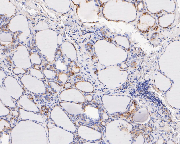 Immunohistochemical analysis of paraffin-embedded human thyroid tissue using anti-FADS1 antibody. The section was pre-treated using heat mediated antigen retrieval with Tris-EDTA buffer (pH 8.0-8.4) for 20 minutes.The tissues were blocked in 5% BSA for 30 minutes at room temperature, washed with ddH2O and PBS, and then probed with the primary antibody (ET7111-19, 1/200) for 30 minutes at room temperature. The detection was performed using an HRP conjugated compact polymer system. DAB was used as the chromogen. Tissues were counterstained with hematoxylin and mounted with DPX.