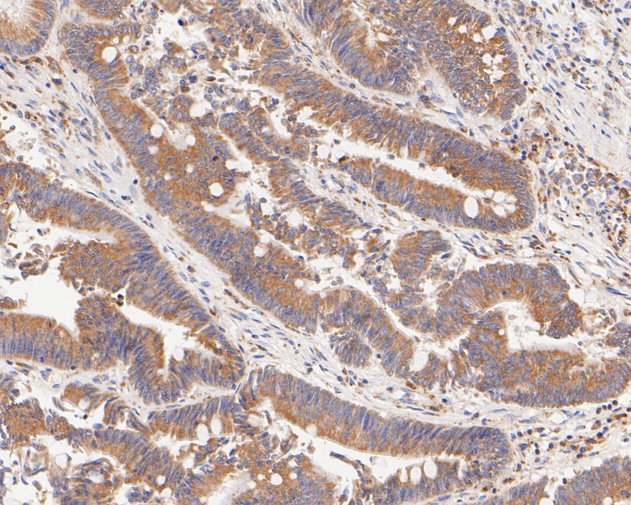 Immunohistochemical analysis of paraffin-embedded human colon carcinoma tissue using anti-FADS1 antibody. The section was pre-treated using heat mediated antigen retrieval with Tris-EDTA buffer (pH 8.0-8.4) for 20 minutes.The tissues were blocked in 5% BSA for 30 minutes at room temperature, washed with ddH2O and PBS, and then probed with the primary antibody (ET7111-19, 1/200) for 30 minutes at room temperature. The detection was performed using an HRP conjugated compact polymer system. DAB was used as the chromogen. Tissues were counterstained with hematoxylin and mounted with DPX.
