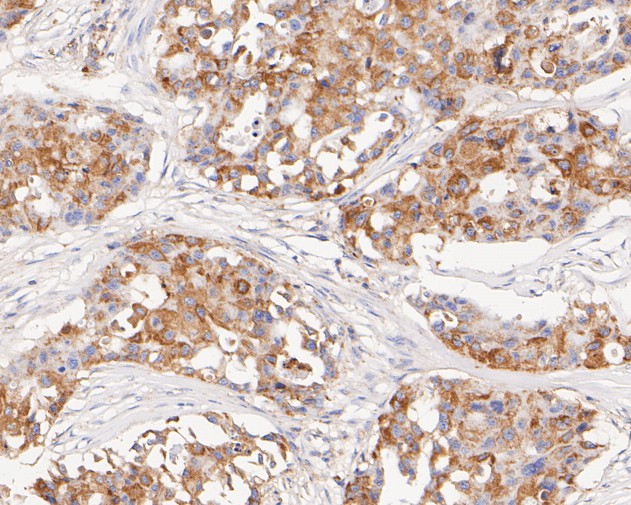 Immunohistochemical analysis of paraffin-embedded human breast carcinoma tissue using anti-FADS1 antibody. The section was pre-treated using heat mediated antigen retrieval with Tris-EDTA buffer (pH 8.0-8.4) for 20 minutes.The tissues were blocked in 5% BSA for 30 minutes at room temperature, washed with ddH2O and PBS, and then probed with the primary antibody (ET7111-19, 1/200) for 30 minutes at room temperature. The detection was performed using an HRP conjugated compact polymer system. DAB was used as the chromogen. Tissues were counterstained with hematoxylin and mounted with DPX.