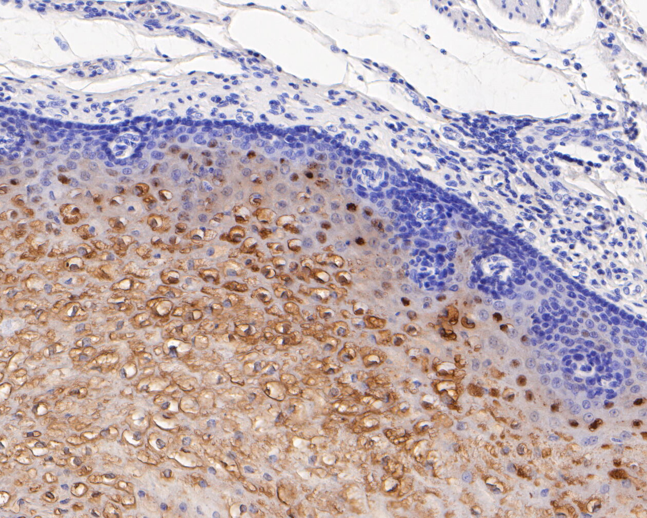 Immunohistochemical analysis of paraffin-embedded human esophagus tissue using anti-SerpinB3 antibody. The section was pre-treated using heat mediated antigen retrieval with Tris-EDTA buffer (pH 8.0-8.4) for 20 minutes.The tissues were blocked in 5% BSA for 30 minutes at room temperature, washed with ddH2O and PBS, and then probed with the primary antibody (ET7111-21, 1/200) for 30 minutes at room temperature. The detection was performed using an HRP conjugated compact polymer system. DAB was used as the chromogen. Tissues were counterstained with hematoxylin and mounted with DPX.