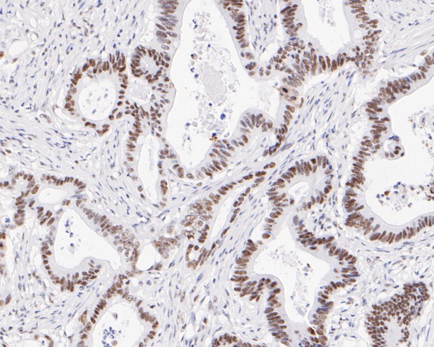 Immunohistochemical analysis of paraffin-embedded human colon carcinoma tissue using anti-NAT10 antibody. The section was pre-treated using heat mediated antigen retrieval with sodium citrate buffer (pH 6.0) for 20 minutes. The tissues were blocked in 5% BSA for 30 minutes at room temperature, washed with ddH2O and PBS, and then probed with the primary antibody (ET7111-23, 1/50)  for 30 minutes at room temperature. The detection was performed using an HRP conjugated compact polymer system. DAB was used as the chromogen. Tissues were counterstained with hematoxylin and mounted with DPX.