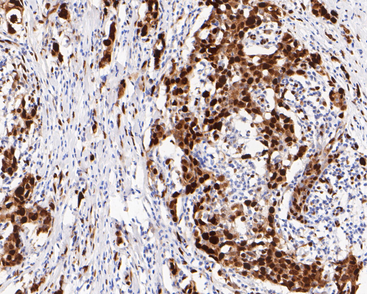 Immunohistochemical analysis of paraffin-embedded human breast carcinoma tissue using anti-CTBP2 antibody. The section was pre-treated using heat mediated antigen retrieval with sodium citrate buffer (pH 6.0) for 20 minutes. The tissues were blocked in 5% BSA for 30 minutes at room temperature, washed with ddH2O and PBS, and then probed with the primary antibody (ET7111-27, 1/200)  for 30 minutes at room temperature. The detection was performed using an HRP conjugated compact polymer system. DAB was used as the chromogen. Tissues were counterstained with hematoxylin and mounted with DPX.