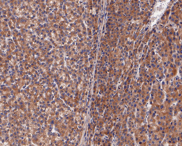 Immunohistochemical analysis of paraffin-embedded human liver carcinoma tissue using anti-UCHL3 antibody. The section was pre-treated using heat mediated antigen retrieval with Tris-EDTA buffer (pH 8.0-8.4) for 20 minutes.The tissues were blocked in 5% BSA for 30 minutes at room temperature, washed with ddH2O and PBS, and then probed with the primary antibody (ET7111-28, 1/50) for 30 minutes at room temperature. The detection was performed using an HRP conjugated compact polymer system. DAB was used as the chromogen. Tissues were counterstained with hematoxylin and mounted with DPX.