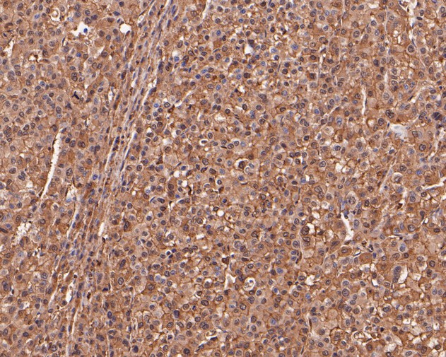 Immunohistochemical analysis of paraffin-embedded human liver carcinoma tissue using anti-MRPL28 antibody. The section was pre-treated using heat mediated antigen retrieval with Tris-EDTA buffer (pH 8.0-8.4) for 20 minutes.The tissues were blocked in 5% BSA for 30 minutes at room temperature, washed with ddH2O and PBS, and then probed with the primary antibody (ET7111-30, 1/200) for 30 minutes at room temperature. The detection was performed using an HRP conjugated compact polymer system. DAB was used as the chromogen. Tissues were counterstained with hematoxylin and mounted with DPX.
