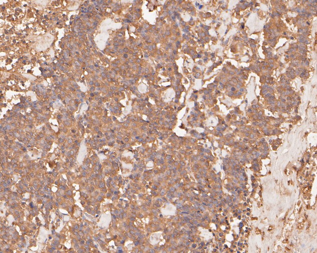 Immunohistochemical analysis of paraffin-embedded human lung carcinoma tissue using anti-PAK1 antibody. The section was pre-treated using heat mediated antigen retrieval with sodium citrate buffer (pH 6.0) for 20 minutes. The tissues were blocked in 5% BSA for 30 minutes at room temperature, washed with ddH2O and PBS, and then probed with the primary antibody (ET7111-33, 1/200)  for 30 minutes at room temperature. The detection was performed using an HRP conjugated compact polymer system. DAB was used as the chromogen. Tissues were counterstained with hematoxylin and mounted with DPX.