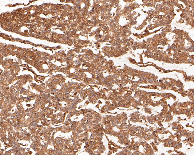 Immunohistochemical analysis of paraffin-embedded human stomach carcinoma tissue using anti-PAK1 antibody. The section was pre-treated using heat mediated antigen retrieval with sodium citrate buffer (pH 6.0) for 20 minutes. The tissues were blocked in 5% BSA for 30 minutes at room temperature, washed with ddH2O and PBS, and then probed with the primary antibody (ET7111-33, 1/200)  for 30 minutes at room temperature. The detection was performed using an HRP conjugated compact polymer system. DAB was used as the chromogen. Tissues were counterstained with hematoxylin and mounted with DPX.