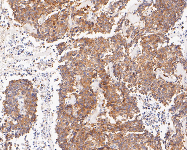 Immunohistochemical analysis of paraffin-embedded human lung carcinoma tissue using anti-EIF2A antibody. The section was pre-treated using heat mediated antigen retrieval with Tris-EDTA buffer (pH 8.0-8.4) for 20 minutes.The tissues were blocked in 5% BSA for 30 minutes at room temperature, washed with ddH2O and PBS, and then probed with the primary antibody (ET7111-34, 1/200) for 30 minutes at room temperature. The detection was performed using an HRP conjugated compact polymer system. DAB was used as the chromogen. Tissues were counterstained with hematoxylin and mounted with DPX.