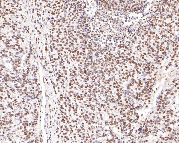 Immunohistochemical analysis of paraffin-embedded human lung carcinoma tissue using anti-MBD2 antibody. The section was pre-treated using heat mediated antigen retrieval with sodium citrate buffer (pH 6.0) for 20 minutes. The tissues were blocked in 5% BSA for 30 minutes at room temperature, washed with ddH2O and PBS, and then probed with the primary antibody (ET7111-40, 1/200)  for 30 minutes at room temperature. The detection was performed using an HRP conjugated compact polymer system. DAB was used as the chromogen. Tissues were counterstained with hematoxylin and mounted with DPX.