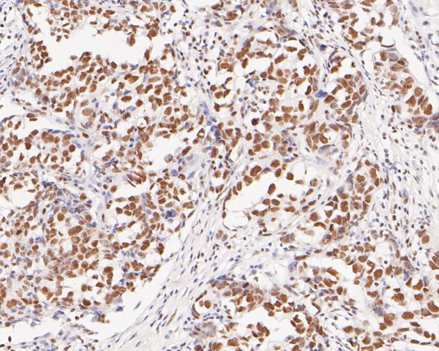 Immunohistochemical analysis of paraffin-embedded human breast carcinoma tissue using anti-MBD2 antibody. The section was pre-treated using heat mediated antigen retrieval with sodium citrate buffer (pH 6.0) for 20 minutes. The tissues were blocked in 5% BSA for 30 minutes at room temperature, washed with ddH2O and PBS, and then probed with the primary antibody (ET7111-40, 1/50)  for 30 minutes at room temperature. The detection was performed using an HRP conjugated compact polymer system. DAB was used as the chromogen. Tissues were counterstained with hematoxylin and mounted with DPX.
