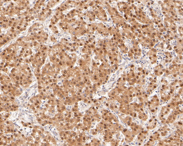 Immunohistochemical analysis of paraffin-embedded human liver carcinoma tissue using anti-HDGF antibody. The section was pre-treated using heat mediated antigen retrieval with sodium citrate buffer (pH 6.0) for 20 minutes. The tissues were blocked in 5% BSA for 30 minutes at room temperature, washed with ddH2O and PBS, and then probed with the primary antibody (ET7111-42, 1/200)  for 30 minutes at room temperature. The detection was performed using an HRP conjugated compact polymer system. DAB was used as the chromogen. Tissues were counterstained with hematoxylin and mounted with DPX.