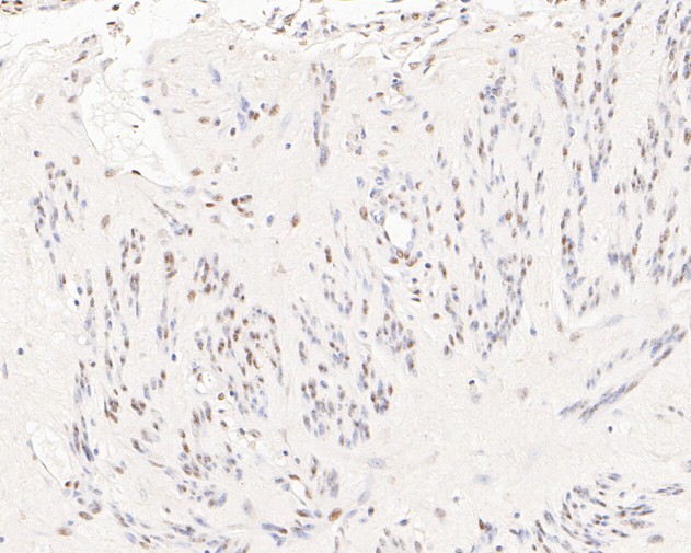 Immunohistochemical analysis of paraffin-embedded human cervix tissue using anti-HDGF antibody. The section was pre-treated using heat mediated antigen retrieval with sodium citrate buffer (pH 6.0) for 20 minutes. The tissues were blocked in 5% BSA for 30 minutes at room temperature, washed with ddH2O and PBS, and then probed with the primary antibody (ET7111-42, 1/200)  for 30 minutes at room temperature. The detection was performed using an HRP conjugated compact polymer system. DAB was used as the chromogen. Tissues were counterstained with hematoxylin and mounted with DPX.