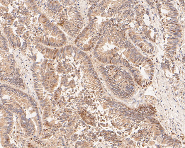 Immunohistochemical analysis of paraffin-embedded human colon carcinoma tissue using anti-HDGF antibody. The section was pre-treated using heat mediated antigen retrieval with sodium citrate buffer (pH 6.0) for 20 minutes. The tissues were blocked in 5% BSA for 30 minutes at room temperature, washed with ddH2O and PBS, and then probed with the primary antibody (ET7111-42, 1/200)  for 30 minutes at room temperature. The detection was performed using an HRP conjugated compact polymer system. DAB was used as the chromogen. Tissues were counterstained with hematoxylin and mounted with DPX.
