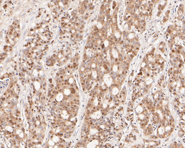 Immunohistochemical analysis of paraffin-embedded human stomach carcinoma tissue using anti-HDGF antibody. The section was pre-treated using heat mediated antigen retrieval with sodium citrate buffer (pH 6.0) for 20 minutes. The tissues were blocked in 5% BSA for 30 minutes at room temperature, washed with ddH2O and PBS, and then probed with the primary antibody (ET7111-42, 1/200)  for 30 minutes at room temperature. The detection was performed using an HRP conjugated compact polymer system. DAB was used as the chromogen. Tissues were counterstained with hematoxylin and mounted with DPX.