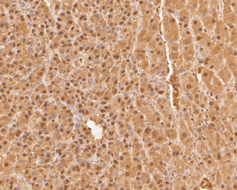Immunohistochemical analysis of paraffin-embedded human liver carcinoma tissue using anti-PSMA7 antibody. The section was pre-treated using heat mediated antigen retrieval with sodium citrate buffer (pH 6.0) for 20 minutes. The tissues were blocked in 5% BSA for 30 minutes at room temperature, washed with ddH2O and PBS, and then probed with the primary antibody (HA500004, 1/400)  for 30 minutes at room temperature. The detection was performed using an HRP conjugated compact polymer system. DAB was used as the chromogen. Tissues were counterstained with hematoxylin and mounted with DPX.