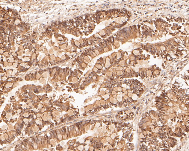 Immunohistochemical analysis of paraffin-embedded human colon carcinoma tissue using anti-LSS antibody. The section was pre-treated using heat mediated antigen retrieval with Tris-EDTA buffer (pH 8.0-8.4) for 20 minutes.The tissues were blocked in 5% BSA for 30 minutes at room temperature, washed with ddH2O and PBS, and then probed with the primary antibody (HA500011, 1/400) for 30 minutes at room temperature. The detection was performed using an HRP conjugated compact polymer system. DAB was used as the chromogen. Tissues were counterstained with hematoxylin and mounted with DPX.
