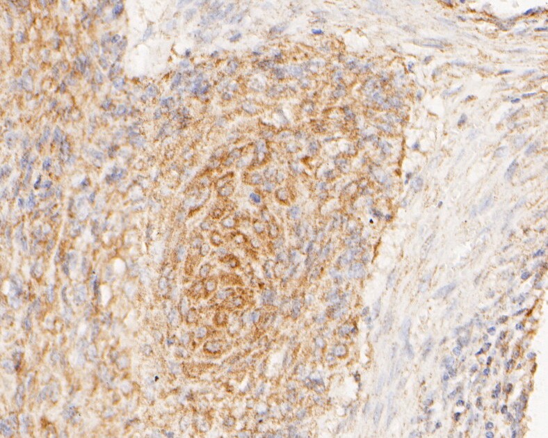 Immunohistochemical analysis of paraffin-embedded human cervical carcinoma tissue using anti-GRIK4 antibody. The section was pre-treated using heat mediated antigen retrieval with Tris-EDTA buffer (pH 8.0-8.4) for 20 minutes.The tissues were blocked in 5% BSA for 30 minutes at room temperature, washed with ddH2O and PBS, and then probed with the primary antibody (HA500017, 1/200) for 30 minutes at room temperature. The detection was performed using an HRP conjugated compact polymer system. DAB was used as the chromogen. Tissues were counterstained with hematoxylin and mounted with DPX.