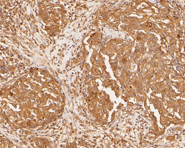 Immunohistochemical analysis of paraffin-embedded human breast carcinoma tissue using anti-PDCD6 antibody. The section was pre-treated using heat mediated antigen retrieval with sodium citrate buffer (pH 6.0) for 20 minutes. The tissues were blocked in 5% BSA for 30 minutes at room temperature, washed with ddH2O and PBS, and then probed with the primary antibody (HA500019, 1/400)  for 30 minutes at room temperature. The detection was performed using an HRP conjugated compact polymer system. DAB was used as the chromogen. Tissues were counterstained with hematoxylin and mounted with DPX.