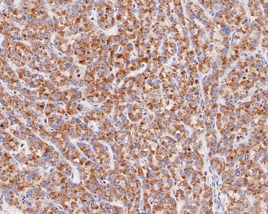 Immunohistochemical analysis of paraffin-embedded human liver carcinoma tissue using anti-ME2 antibody. The section was pre-treated using heat mediated antigen retrieval with Tris-EDTA buffer (pH 8.0-8.4) for 20 minutes.The tissues were blocked in 5% BSA for 30 minutes at room temperature, washed with ddH2O and PBS, and then probed with the primary antibody (HA500022, 1/800) for 30 minutes at room temperature. The detection was performed using an HRP conjugated compact polymer system. DAB was used as the chromogen. Tissues were counterstained with hematoxylin and mounted with DPX.