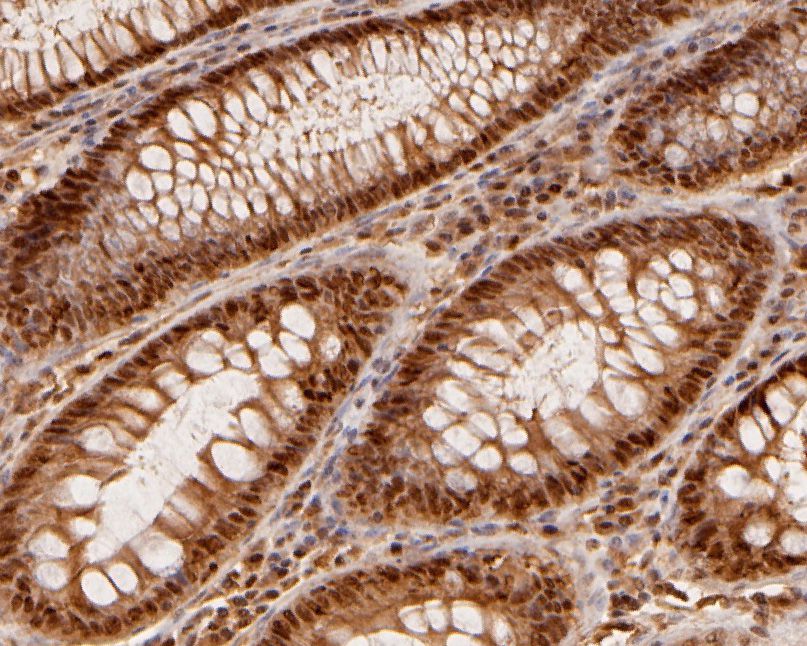Immunohistochemical analysis of paraffin-embedded human colon tissue using anti-MAT2A antibody. The section was pre-treated using heat mediated antigen retrieval with sodium citrate buffer (pH 6.0) for 20 minutes. The tissues were blocked in 5% BSA for 30 minutes at room temperature, washed with ddH2O and PBS, and then probed with the primary antibody (HA500028, 1/800)  for 30 minutes at room temperature. The detection was performed using an HRP conjugated compact polymer system. DAB was used as the chromogen. Tissues were counterstained with hematoxylin and mounted with DPX.