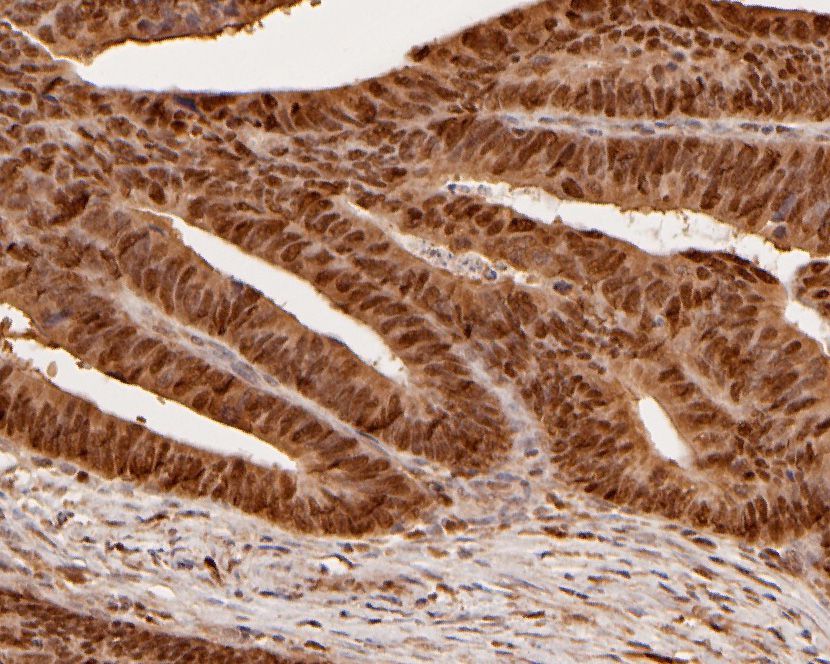 Immunohistochemical analysis of paraffin-embedded human colon carcinoma tissue using anti-MAT2A antibody. The section was pre-treated using heat mediated antigen retrieval with sodium citrate buffer (pH 6.0) for 20 minutes. The tissues were blocked in 5% BSA for 30 minutes at room temperature, washed with ddH2O and PBS, and then probed with the primary antibody (HA500028, 1/800)  for 30 minutes at room temperature. The detection was performed using an HRP conjugated compact polymer system. DAB was used as the chromogen. Tissues were counterstained with hematoxylin and mounted with DPX.