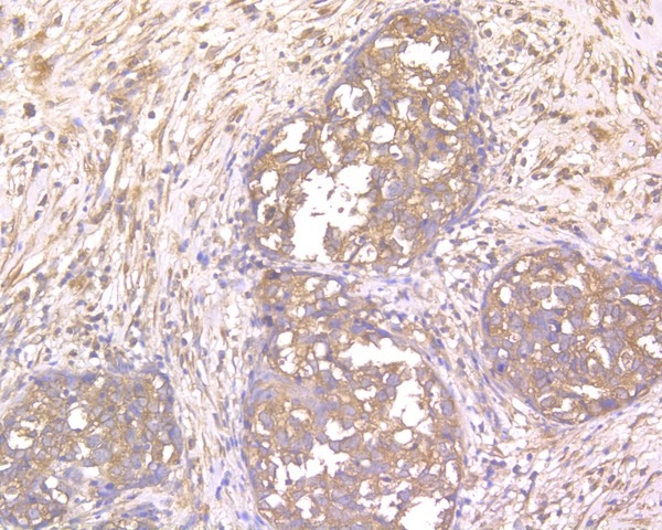 Immunohistochemical analysis of paraffin-embedded human breast carcinoma tissue using anti-NLK antibody. The section was pre-treated using heat mediated antigen retrieval with Tris-EDTA buffer (pH 8.0-8.4) for 20 minutes.The tissues were blocked in 5% BSA for 30 minutes at room temperature, washed with ddH2O and PBS, and then probed with the primary antibody (HA500033, 1/200) for 30 minutes at room temperature. The detection was performed using an HRP conjugated compact polymer system. DAB was used as the chromogen. Tissues were counterstained with hematoxylin and mounted with DPX.