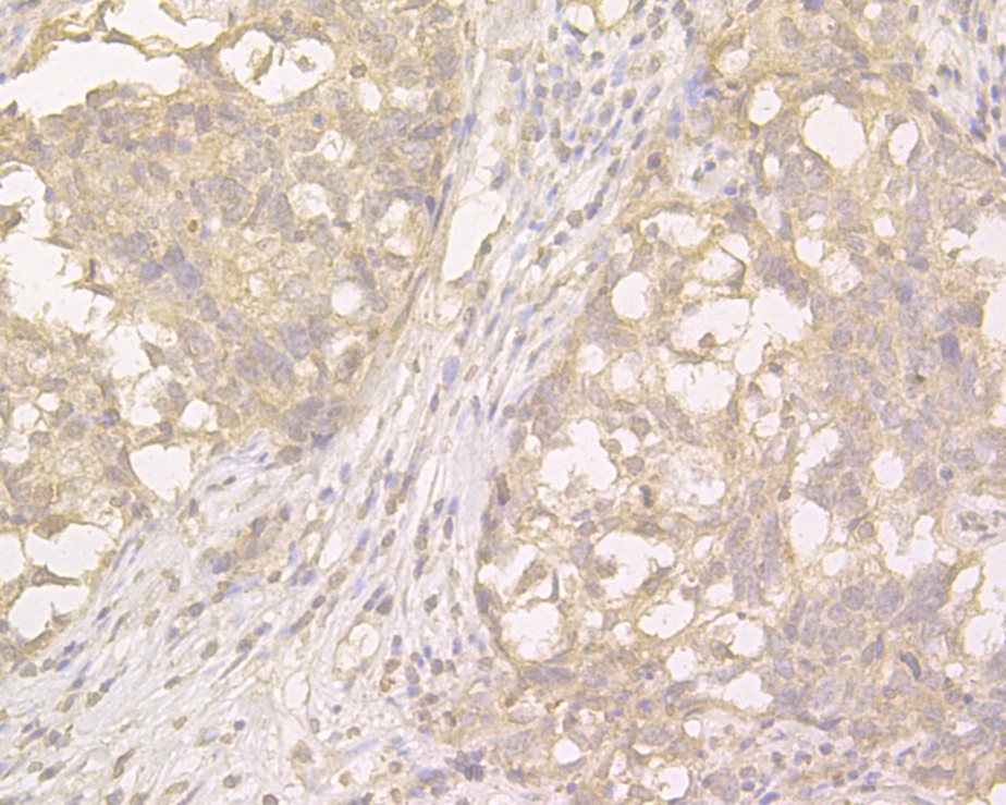 Immunohistochemical analysis of paraffin-embedded human breast carcinoma tissue using anti-Plakophilin 3 antibody. The section was pre-treated using heat mediated antigen retrieval with sodium citrate buffer (pH 6.0) for 20 minutes. The tissues were blocked in 5% BSA for 30 minutes at room temperature, washed with ddH2O and PBS, and then probed with the primary antibody (HA500034, 1/1,500)  for 30 minutes at room temperature. The detection was performed using an HRP conjugated compact polymer system. DAB was used as the chromogen. Tissues were counterstained with hematoxylin and mounted with DPX.