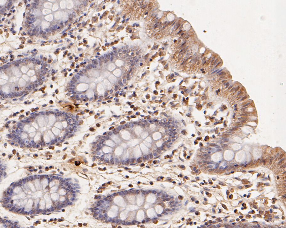 Immunohistochemical analysis of paraffin-embedded human colon tissue using anti-CCL2/MCP1 antibody. The section was pre-treated using heat mediated antigen retrieval with Tris-EDTA buffer (pH 8.0-8.4) for 20 minutes.The tissues were blocked in 5% BSA for 30 minutes at room temperature, washed with ddH2O and PBS, and then probed with the primary antibody (HA500042, 1/800) for 30 minutes at room temperature. The detection was performed using an HRP conjugated compact polymer system. DAB was used as the chromogen. Tissues were counterstained with hematoxylin and mounted with DPX.