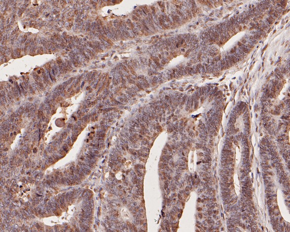 Immunohistochemical analysis of paraffin-embedded human colon carcinoma tissue using anti-CCL2/MCP1 antibody. The section was pre-treated using heat mediated antigen retrieval with Tris-EDTA buffer (pH 8.0-8.4) for 20 minutes.The tissues were blocked in 5% BSA for 30 minutes at room temperature, washed with ddH2O and PBS, and then probed with the primary antibody (HA500042, 1/200) for 30 minutes at room temperature. The detection was performed using an HRP conjugated compact polymer system. DAB was used as the chromogen. Tissues were counterstained with hematoxylin and mounted with DPX.