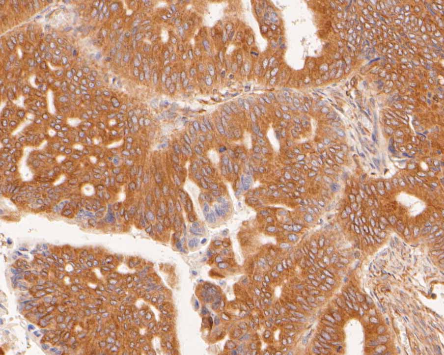 Immunohistochemical analysis of paraffin-embedded human rectal cancer tissue using anti-SLC27A4 antibody. The section was pre-treated using heat mediated antigen retrieval with Tris-EDTA buffer (pH 8.0-8.4) for 20 minutes.The tissues were blocked in 5% BSA for 30 minutes at room temperature, washed with ddH2O and PBS, and then probed with the primary antibody (HA720001, 1/50) for 30 minutes at room temperature. The detection was performed using an HRP conjugated compact polymer system. DAB was used as the chromogen. Tissues were counterstained with hematoxylin and mounted with DPX.