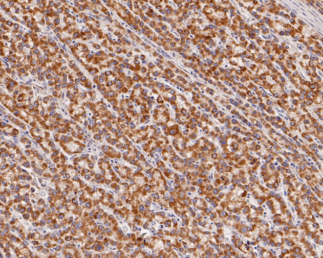 Immunohistochemical analysis of paraffin-embedded human liver carcinoma tissue using anti-Sulfite oxidase antibody. The section was pre-treated using heat mediated antigen retrieval with Tris-EDTA buffer (pH 8.0-8.4) for 20 minutes.The tissues were blocked in 5% BSA for 30 minutes at room temperature, washed with ddH2O and PBS, and then probed with the primary antibody (HA720008, 1/200) for 30 minutes at room temperature. The detection was performed using an HRP conjugated compact polymer system. DAB was used as the chromogen. Tissues were counterstained with hematoxylin and mounted with DPX.