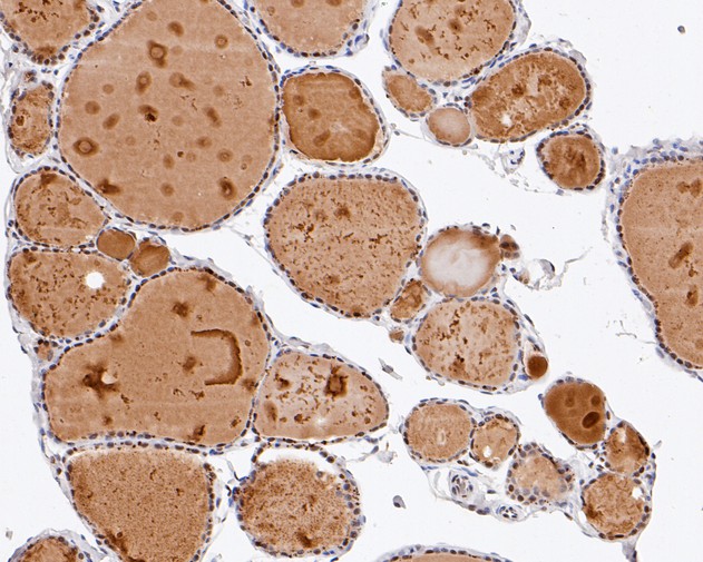 Immunohistochemical analysis of paraffin-embedded human thyroid tissue using anti-CHD3 antibody. The section was pre-treated using heat mediated antigen retrieval with sodium citrate buffer (pH 6.0) for 20 minutes. The tissues were blocked in 5% BSA for 30 minutes at room temperature, washed with ddH2O and PBS, and then probed with the primary antibody (HA720011, 1/200)  for 30 minutes at room temperature. The detection was performed using an HRP conjugated compact polymer system. DAB was used as the chromogen. Tissues were counterstained with hematoxylin and mounted with DPX.