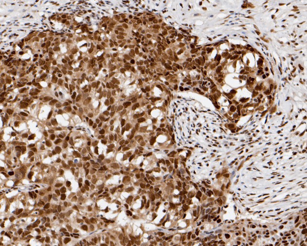 Immunohistochemical analysis of paraffin-embedded human breast carcinoma tissue using anti-CHD3 antibody. The section was pre-treated using heat mediated antigen retrieval with sodium citrate buffer (pH 6.0) for 20 minutes. The tissues were blocked in 5% BSA for 30 minutes at room temperature, washed with ddH2O and PBS, and then probed with the primary antibody (HA720011, 1/50)  for 30 minutes at room temperature. The detection was performed using an HRP conjugated compact polymer system. DAB was used as the chromogen. Tissues were counterstained with hematoxylin and mounted with DPX.