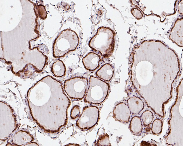 Immunohistochemical analysis of paraffin-embedded human thyroid tissue using anti-SBDS antibody. The section was pre-treated using heat mediated antigen retrieval with sodium citrate buffer (pH 6.0) for 20 minutes. The tissues were blocked in 5% BSA for 30 minutes at room temperature, washed with ddH2O and PBS, and then probed with the primary antibody (HA720012, 1/200)  for 30 minutes at room temperature. The detection was performed using an HRP conjugated compact polymer system. DAB was used as the chromogen. Tissues were counterstained with hematoxylin and mounted with DPX.
