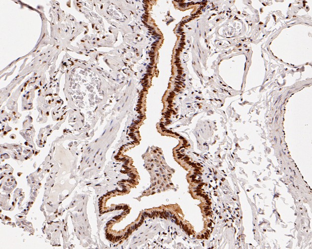 Immunohistochemical analysis of paraffin-embedded human lung tissue using anti-HDGF antibody. The section was pre-treated using heat mediated antigen retrieval with sodium citrate buffer (pH 6.0) for 20 minutes. The tissues were blocked in 5% BSA for 30 minutes at room temperature, washed with ddH2O and PBS, and then probed with the primary antibody (HA720013, 1/200)  for 30 minutes at room temperature. The detection was performed using an HRP conjugated compact polymer system. DAB was used as the chromogen. Tissues were counterstained with hematoxylin and mounted with DPX.
