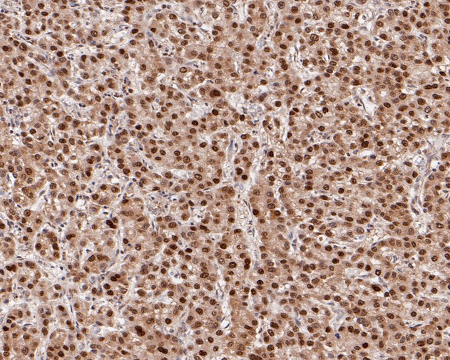 Immunohistochemical analysis of paraffin-embedded human liver carcinoma tissue using anti-HDGF antibody. The section was pre-treated using heat mediated antigen retrieval with sodium citrate buffer (pH 6.0) for 20 minutes. The tissues were blocked in 5% BSA for 30 minutes at room temperature, washed with ddH2O and PBS, and then probed with the primary antibody (HA720013, 1/200)  for 30 minutes at room temperature. The detection was performed using an HRP conjugated compact polymer system. DAB was used as the chromogen. Tissues were counterstained with hematoxylin and mounted with DPX.