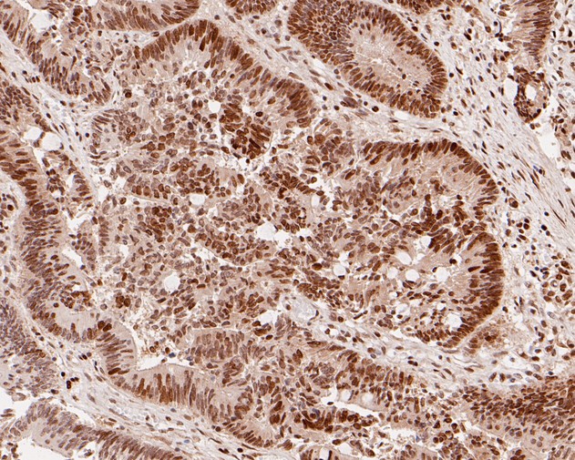 Immunohistochemical analysis of paraffin-embedded human colon carcinoma tissue using anti-HDGF antibody. The section was pre-treated using heat mediated antigen retrieval with sodium citrate buffer (pH 6.0) for 20 minutes. The tissues were blocked in 5% BSA for 30 minutes at room temperature, washed with ddH2O and PBS, and then probed with the primary antibody (HA720013, 1/200)  for 30 minutes at room temperature. The detection was performed using an HRP conjugated compact polymer system. DAB was used as the chromogen. Tissues were counterstained with hematoxylin and mounted with DPX.