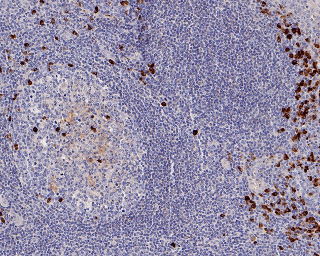 Immunohistochemical analysis of paraffin-embedded human breast carcinoma tissue using anti-Human Kappa light chain antibody. The section was pre-treated using heat mediated antigen retrieval with Tris-EDTA buffer (pH 8.0-8.4) for 20 minutes.The tissues were blocked in 5% BSA for 30 minutes at room temperature, washed with ddH2O and PBS, and then probed with the primary antibody (HA720014, 1/50) for 30 minutes at room temperature. The detection was performed using an HRP conjugated compact polymer system. DAB was used as the chromogen. Tissues were counterstained with hematoxylin and mounted with DPX.