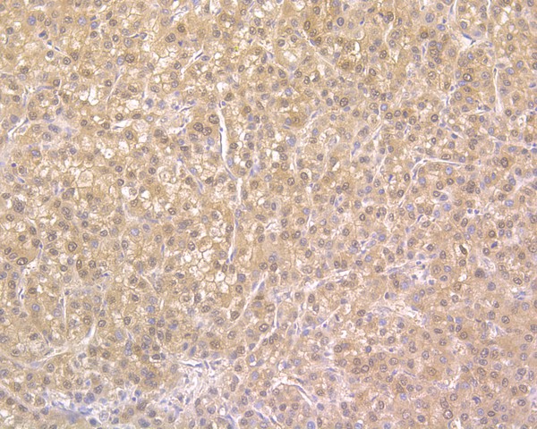 Immunohistochemical analysis of paraffin-embedded human liver carcinoma tissue using anti-NUDT5 antibody. The section was pre-treated using heat mediated antigen retrieval with sodium citrate buffer (pH 6.0) for 20 minutes. The tissues were blocked in 5% BSA for 30 minutes at room temperature, washed with ddH2O and PBS, and then probed with the primary antibody (HA720015, 1/500)  for 30 minutes at room temperature. The detection was performed using an HRP conjugated compact polymer system. DAB was used as the chromogen. Tissues were counterstained with hematoxylin and mounted with DPX.