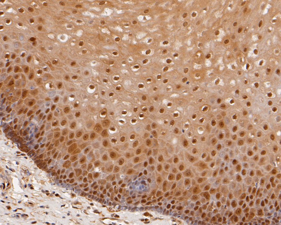 Immunohistochemical analysis of paraffin-embedded human esophagus tissue using anti-Olig3 antibody. The section was pre-treated using heat mediated antigen retrieval with sodium citrate buffer (pH 6.0) for 20 minutes. The tissues were blocked in 5% BSA for 30 minutes at room temperature, washed with ddH2O and PBS, and then probed with the primary antibody (HA720016, 1/200)  for 30 minutes at room temperature. The detection was performed using an HRP conjugated compact polymer system. DAB was used as the chromogen. Tissues were counterstained with hematoxylin and mounted with DPX.