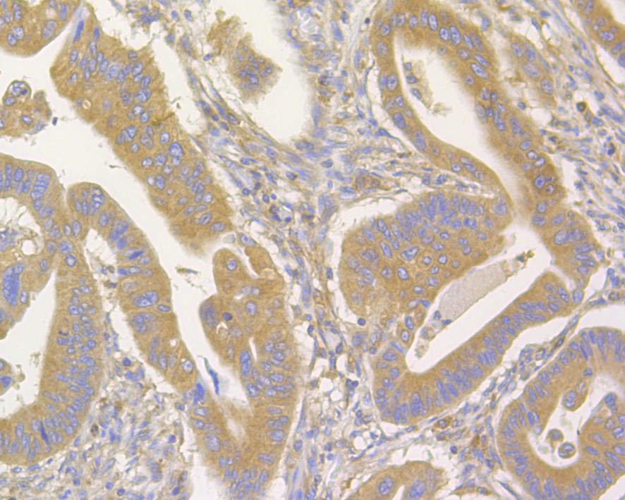 Immunohistochemical analysis of paraffin-embedded human colon carcinoma tissue using anti-FAM62B antibody. The section was pre-treated using heat mediated antigen retrieval with Tris-EDTA buffer (pH 8.0-8.4) for 20 minutes.The tissues were blocked in 5% BSA for 30 minutes at room temperature, washed with ddH2O and PBS, and then probed with the primary antibody (M1009-1, 1/100) for 30 minutes at room temperature. The detection was performed using an HRP conjugated compact polymer system. DAB was used as the chromogen. Tissues were counterstained with hematoxylin and mounted with DPX.