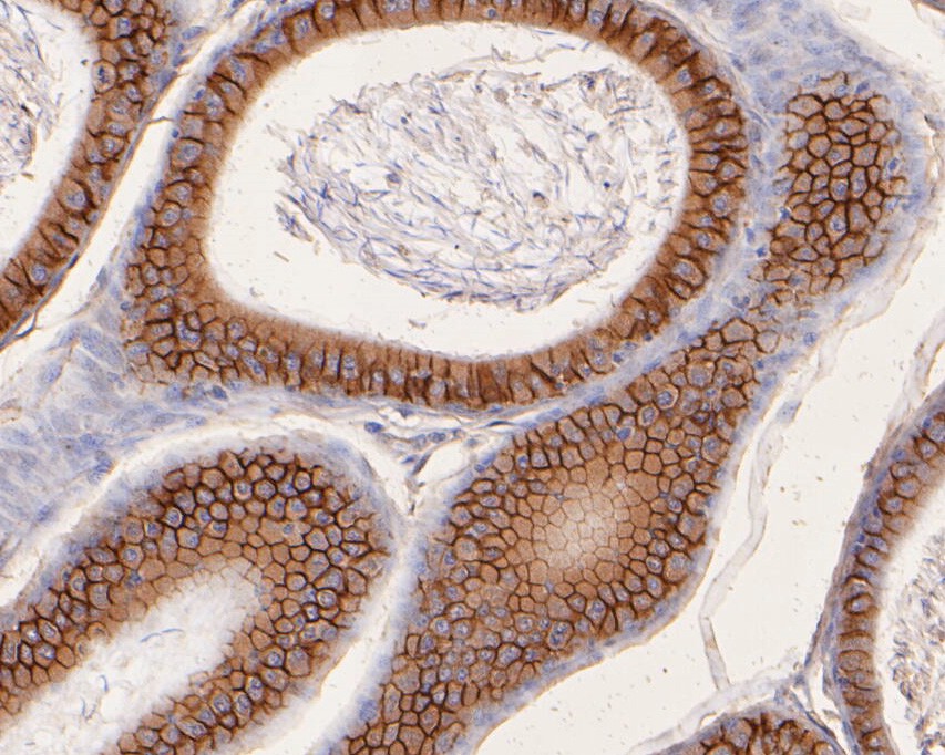 Immunohistochemical analysis of paraffin-embedded human breast cancer tissue using anti-CD166 antibody. The section was pre-treated using heat mediated antigen retrieval with Tris-EDTA buffer (pH 8.0-8.4) for 20 minutes.The tissues were blocked in 5% BSA for 30 minutes at room temperature, washed with ddH2O and PBS, and then probed with the primary antibody (M1012-7, 1/200) for 30 minutes at room temperature. The detection was performed using an HRP conjugated compact polymer system. DAB was used as the chromogen. Tissues were counterstained with hematoxylin and mounted with DPX.