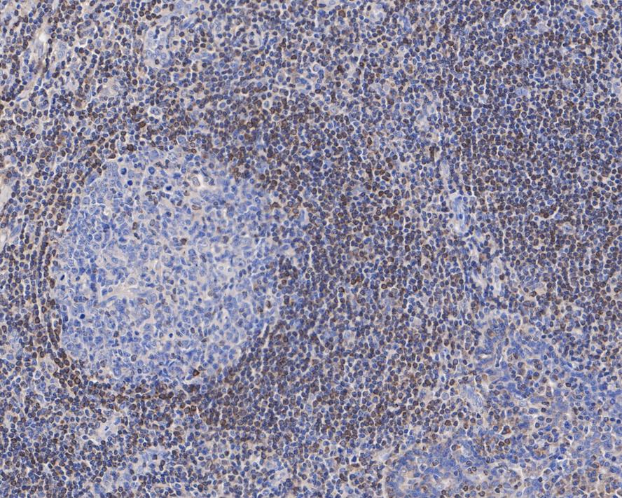 Immunohistochemical analysis of paraffin-embedded human tonsil  tissue using anti-BCL2 antibody. The section was pre-treated using heat mediated antigen retrieval with Tris-EDTA buffer (pH 8.0-8.4) for 20 minutes.The tissues were blocked in 5% BSA for 30 minutes at room temperature, washed with ddH2O and PBS, and then probed with the primary antibody (EM1701-83, 1/200) for 30 minutes at room temperature. The detection was performed using an HRP conjugated compact polymer system. DAB was used as the chromogen. Tissues were counterstained with hematoxylin and mounted with DPX.