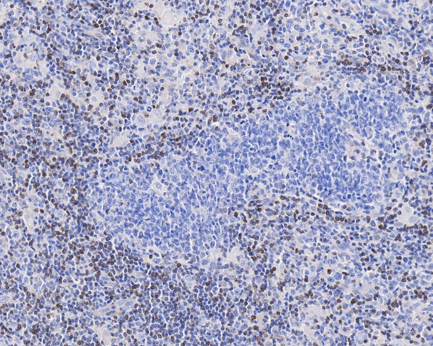 Immunohistochemical analysis of paraffin-embedded human thyroid tissue using anti-BCL2 antibody. The section was pre-treated using heat mediated antigen retrieval with Tris-EDTA buffer (pH 8.0-8.4) for 20 minutes.The tissues were blocked in 5% BSA for 30 minutes at room temperature, washed with ddH2O and PBS, and then probed with the primary antibody (EM1701-83, 1/50) for 30 minutes at room temperature. The detection was performed using an HRP conjugated compact polymer system. DAB was used as the chromogen. Tissues were counterstained with hematoxylin and mounted with DPX.