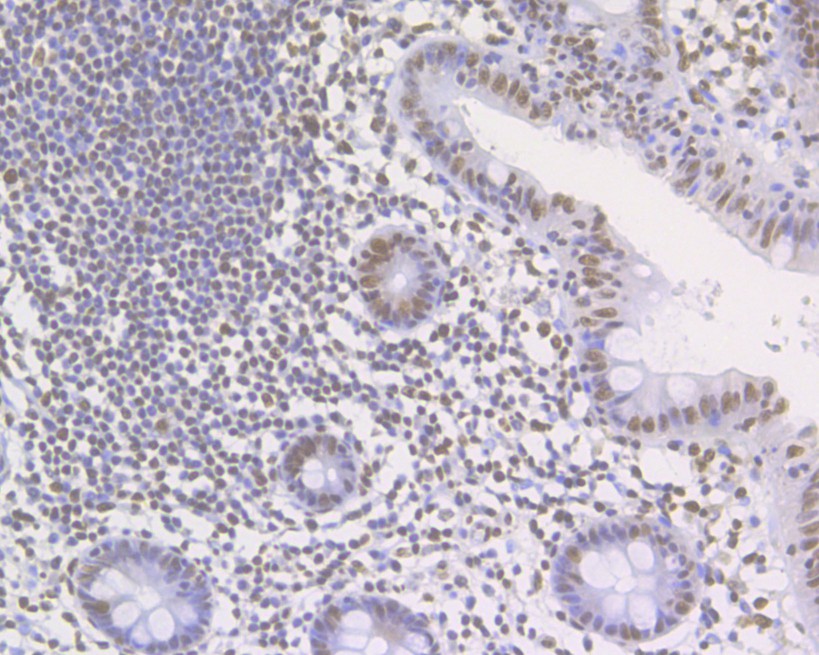 Immunohistochemical analysis of paraffin-embedded human colon carcinoma tissue using anti-Histone H3 (acetyl K27) antibody. The section was pre-treated using heat mediated antigen retrieval with sodium citrate buffer (pH 6.0) for 20 minutes. The tissues were blocked in 5% BSA for 30 minutes at room temperature, washed with ddH2O and PBS, and then probed with the primary antibody (HA500046, 1/500) for 30 minutes at room temperature. The detection was performed using an HRP conjugated compact polymer system. DAB was used as the chromogen. Tissues were counterstained with hematoxylin and mounted with DPX.