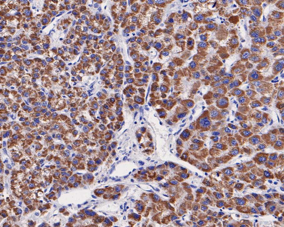 Immunohistochemical analysis of paraffin-embedded human liver carcinoma tissue using anti-OTC/Ornithine Carbamoyltransferase antibody. The section was pre-treated using heat mediated antigen retrieval with Tris-EDTA buffer (pH 8.0-8.4) for 20 minutes.The tissues were blocked in 5% BSA for 30 minutes at room temperature, washed with ddH2O and PBS, and then probed with the primary antibody (HA500048, 1/400) for 30 minutes at room temperature. The detection was performed using an HRP conjugated compact polymer system. DAB was used as the chromogen. Tissues were counterstained with hematoxylin and mounted with DPX.